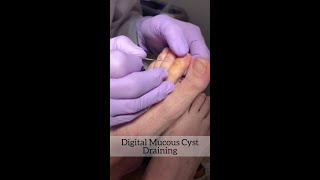 Mucous Cyst Draining [upl. by Ayhtin783]