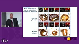 Advancements in intracoronary imaging and intervention unmasking vulnerable plaques  EuroPCR [upl. by Branham]