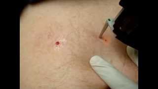 Cherry Angiomas Red Moles Treatment [upl. by Neellek]