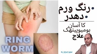 RINGWORM TREATMENT WITH HOMOEOPATHIC MEDICINESरिंग वर्म ट्रीटमेंटURDUHINDI DR AZHAR IQBAL [upl. by Thorn]