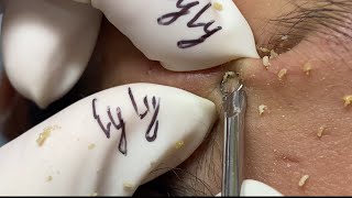 99 2024 Acne Treatment for “ MAI ANH” part 1  LyLyBeautySpa [upl. by Htebaile]