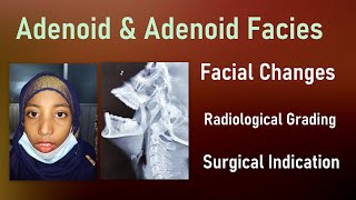 Adenoid । Adenoid Facies। Clinical Features। Clemens Grading।Adenoidectomy Indications [upl. by Alieka]