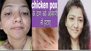 HOW TO REMOVE CHICKEN POX SPOTSSCARS 100 work [upl. by Wagstaff]