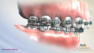 Orthodontics Treatment for Overjet Overbite  Headgear vs Forsus Appliance [upl. by Emelin]