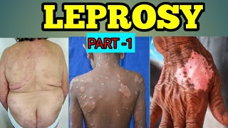 LEPROSY Full Animation 3D video leprosydiseaseskininfectionbiologymedicinembbsmedicalbio [upl. by Dierdre]