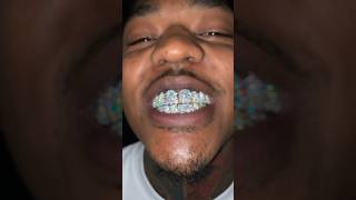 Jumbo VVS Diamond Grillz 🥶MOISSANITEBAZAARCOM moissanitejewellery goldgrillz grillz L [upl. by Kaasi167]