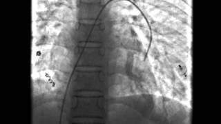 Hereditary Haemorrhagic Telangiectasia [upl. by Inesita]