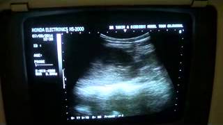 PYELONEPHRITIS vs INTERSTITIAL NEPHRITIS vs NEPHROTIC SYNDROME [upl. by Sanez220]