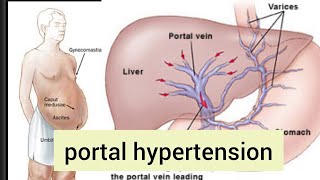 portal hypertension in hindi  hepatology in hindi  MBBS  BHMS  BAMS LECTURES [upl. by Nikola]