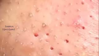 Blackhead Removal on his nose  Acne Treatment  Remove Blackhead removeblackhead [upl. by Seppala]