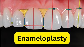 What is enameloplasty or odontoplasty [upl. by Lacsap]