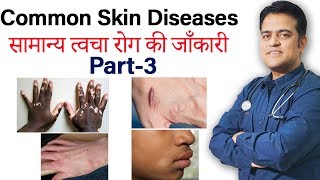 Treatment of pityriasis alba  Treatment of common skin problem  Keloid  Vitiligo  Scabies [upl. by Kieryt]