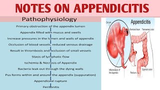 MSN 40 Notes on Appendicitiswith pathophysiologyGastro Intestinal Disorders LearnNursingEasy [upl. by Zebedee]