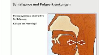 Schlafapnoe und ihre Folgeerkrankungen [upl. by Liscomb]