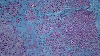 006 Intradermal nevus Histology HEA50 stain [upl. by Formenti752]