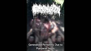 FERMENTATION  GENERALIZED PERITONITIS DUE TO PUERPERAL SEPSIS SINGLE 2022 [upl. by Ayikat380]