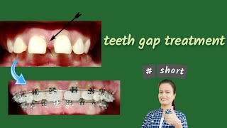 teeth gap treatment  Braces [upl. by Beaver]