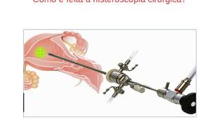 Histeroscopia cirúrgica [upl. by Arzed608]