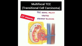 Case report Multicentric Transitional Cell Carcinoma TCC CT AbdomenRadiology 20 [upl. by Perr]