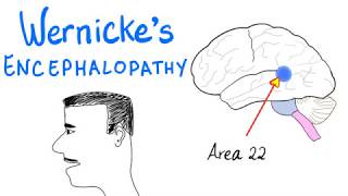 Wernickes Aphasia Fluent Aphasia  Neurology [upl. by Notnek75]