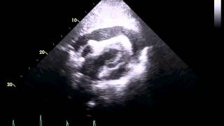 Echocardiogram of a Patient With Cardiac Tamponade [upl. by Bakeman]