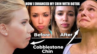 Botox to the Chin Before and Afters  What is Cobblestone chin [upl. by Huang]