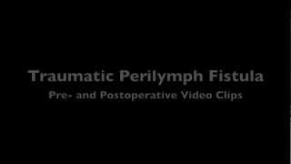 Perilymph Fistula [upl. by Reemas]