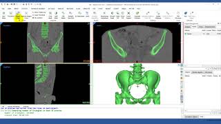 How to Use RegionGrowing in Mimics  Mimics Innovation Suite  Materialise Medical [upl. by Buskirk]