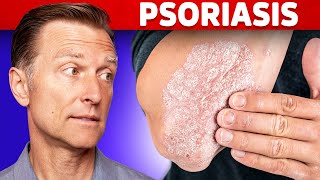 How to use topical steroids [upl. by Atenahs]