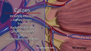 Ureteral Stricture  KU Urology [upl. by Aspia]