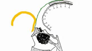 pericranial flapmp4 [upl. by Doersten]