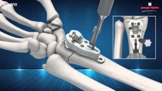 Distal Radius Plate VISIOFIX Concept amp Surgical Technique 3D Animation [upl. by Biel]