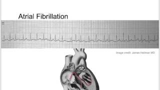 Tachycardia Basic Discussion [upl. by Nesaj]