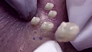 Big Cystic Acne Blackheads Extraction Blackheads amp Milia Whiteheads Removal Pimple Popping 019 [upl. by Alohcin558]