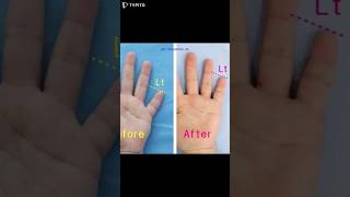 brachydactyly brachydactylytypeD 短指症手術 短指症 大拇指短粗 マムシ指 しゃもじ指 まむし指 우렁손톱 단지증 단지증수술 단지증수술후기 [upl. by Heger]