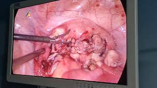 Laparoscopic myomactomy surgery haemostatic Intraoperative procedure [upl. by Enutrof]