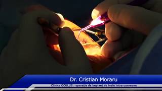 Dr Cristian Moraru  Operatie de implant de inele intracorneene cu tehnologia femtoLaser [upl. by Kulsrud]