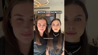 BOTOX VS NO BOTOX antiaging botulinumtoxin [upl. by Alicec]