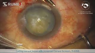 Surgery Live Cutting Corneal Tissue [upl. by Angelina889]