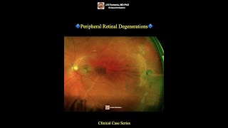 Peripheral Retinal Degenerations [upl. by Tasiana]