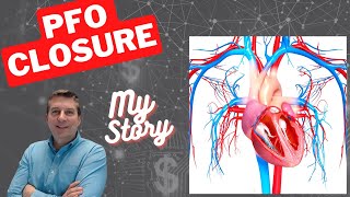 My PFO Closure Story  Patent Foramen Ovale Closure  Post Stroke [upl. by Schnurr5]