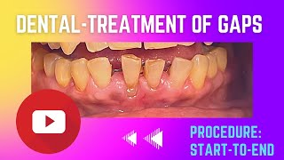 Dental Treatment for loose weak and spacedout teeth Joined Crowns [upl. by Silberman]