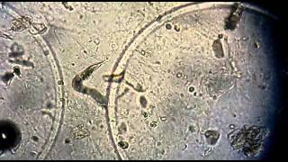 Strongyloides stercoralis no exame de urina EAS [upl. by Ev]