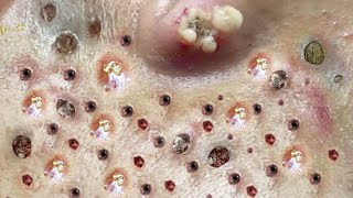 Blackhead Removal With Sac Dep Spa 100074051 [upl. by Rento]