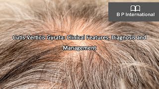 Cutis Verticis Gyrata Clinical Features Diagnosis and Management [upl. by Ellison]