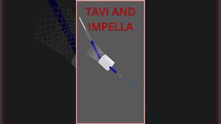 IMPELLA AND TAVI INTERACTION impella [upl. by Gerard]