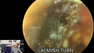 Khám tai cho người khuyết tật  BS LẠI MINH TUẤN [upl. by Llechtim]