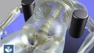 Sciatica  Spinal Decompression  Back Clinics of Canada [upl. by Iroj]