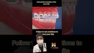 OPEN BITE BRACESORTHODONTICS oralhealth viral smile trending youtubeshorts shorts [upl. by Qooraf]