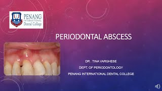 Periodontal Abscess [upl. by Yelsnik]